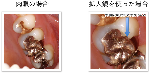 よりよい治療をするために【拡大鏡】を使用する